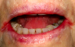 angular cheilitis