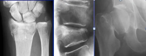 Loss of Bone Density osteoporotic fractures