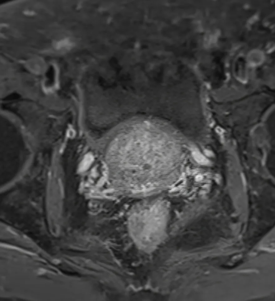 prostate MRI
